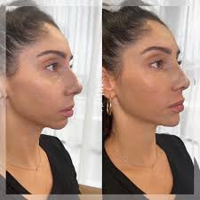 Lip Filler Specialists in Your Neighborhood post thumbnail image